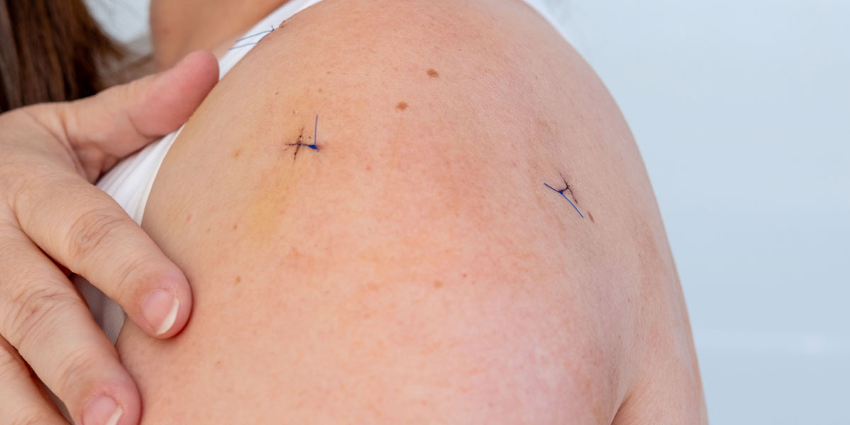 Αρθροσκόπηση Ώμου